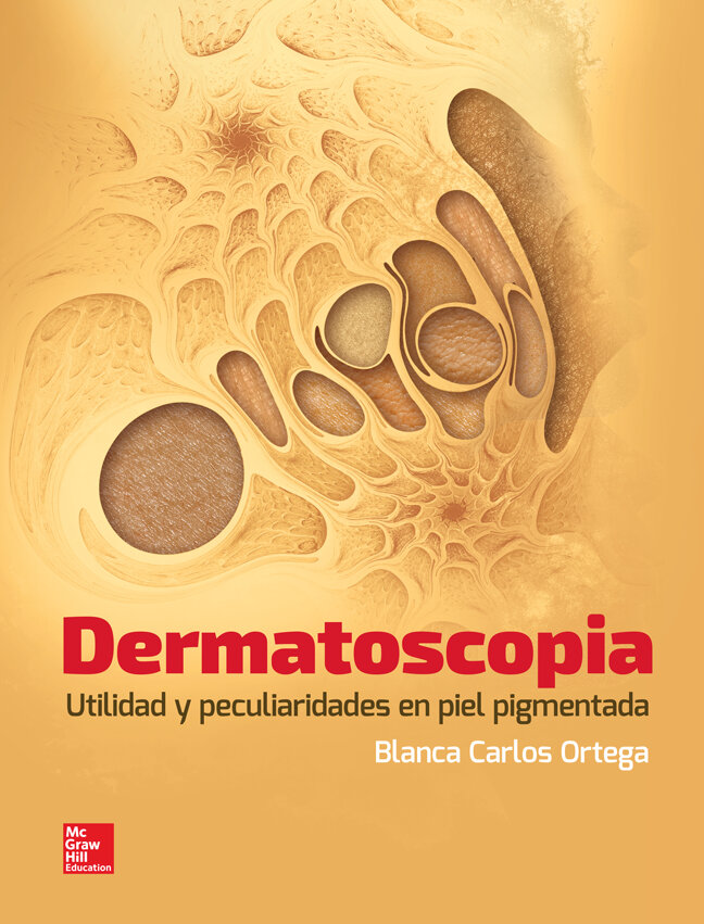 DERMATOSCOPIA UTILIDAD Y PECULIARIDADES EN PIEL PIGMENTADA+++